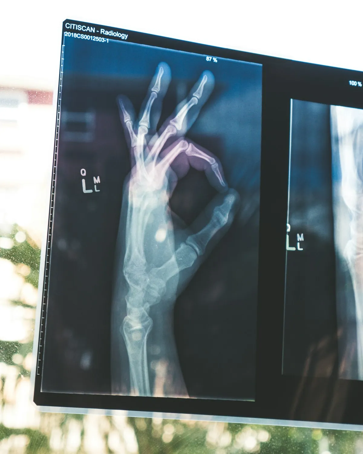 Radiografía de una mano en el monitor de diagnóstico